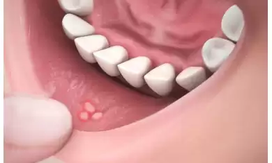 Ağız Yarası (AFT)