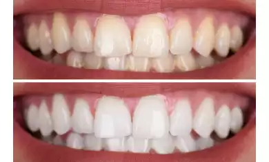 Diş Beyazlatma Uygulaması Herkes Yaptırabilir Mi?