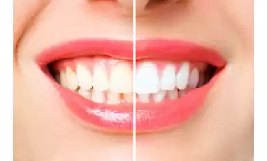 Diş Beyazlatma Yöntemleri Nelerdir?