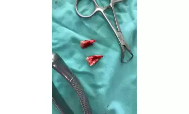 Gömülü Diş Nedir?