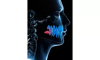 Gömülü Kanin yada Premolar Dişlerin Tedavisi Nasıl Olur?