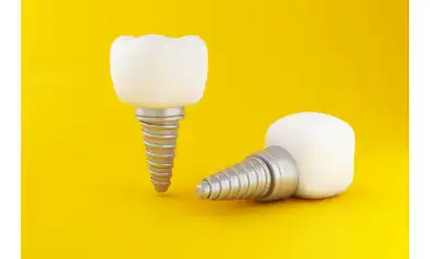 4 Things You Should Know Before Getting an Implant 