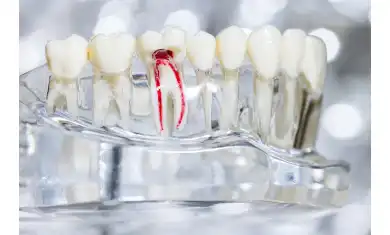 Kanal Tedavisi Acıtır Mı?