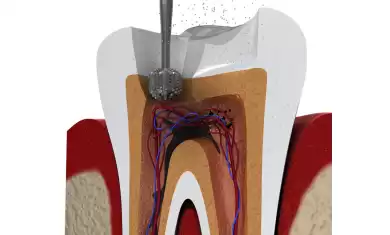 Kanal Tedavisi Sırasında Ağrı Hisseder Miyim?