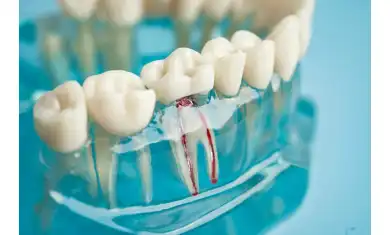 Kanal Tedavisi Sonrası Dikkat Edilmesi Gerekenler