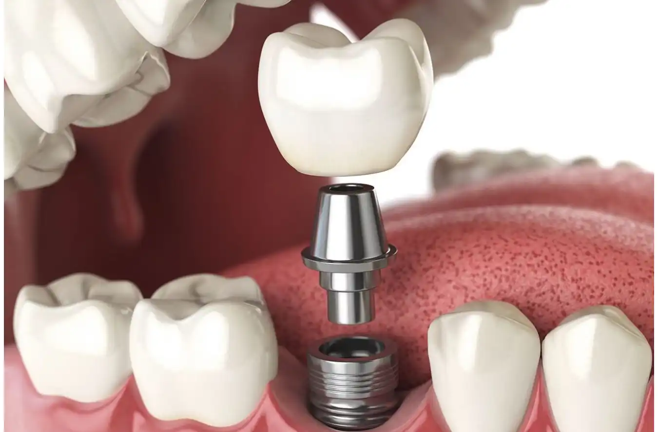 Yapılan implantı değil, estetiğinizi ve konforunuzu <br>hedefliyoruz.