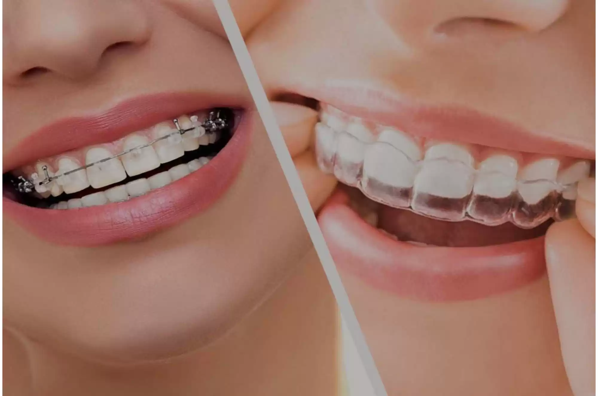 Çapraşık ve uyumsuz<br> diş diziliminiz mi var? 